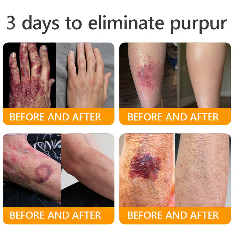 Lotmay® 𝘽𝙀𝙀 𝙑𝙀𝙉𝙊𝙈 𝑺𝒌𝒊𝒏 𝑹𝒆𝒔𝒕𝒐𝒓𝒂𝒕𝒊𝒐𝒏 𝑪𝒓𝒆𝒂𝒎 –🌸 Anti-aging,Hydrating, Skin Repair, Even Tone, Acne and Dark Spot Treatment, Wart and Mole Removal, Psoriasis Relief