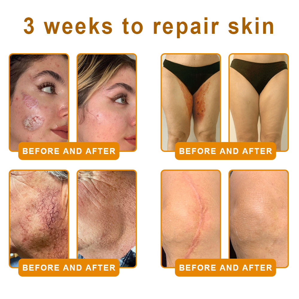 Lotmay® 𝘽𝙀𝙀 𝙑𝙀𝙉𝙊𝙈 𝑺𝒌𝒊𝒏 𝑹𝒆𝒔𝒕𝒐𝒓𝒂𝒕𝒊𝒐𝒏 𝑪𝒓𝒆𝒂𝒎 –🌸 Anti-aging,Hydrating, Skin Repair, Even Tone, Acne and Dark Spot Treatment, Wart and Mole Removal, Psoriasis Relief