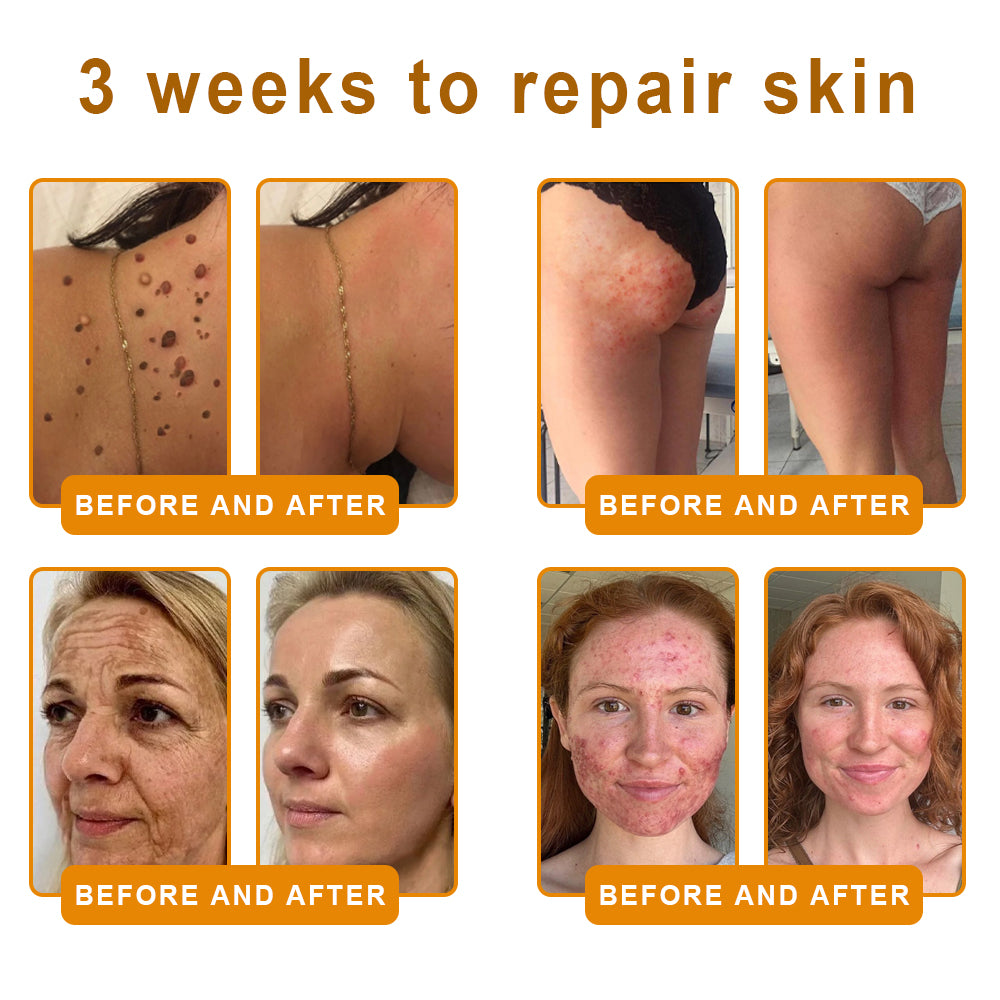 Lotmay® 𝘽𝙀𝙀 𝙑𝙀𝙉𝙊𝙈 𝑺𝒌𝒊𝒏 𝑹𝒆𝒔𝒕𝒐𝒓𝒂𝒕𝒊𝒐𝒏 𝑪𝒓𝒆𝒂𝒎 –🌸 Anti-aging,Hydrating, Skin Repair, Even Tone, Acne and Dark Spot Treatment, Wart and Mole Removal, Psoriasis Relief